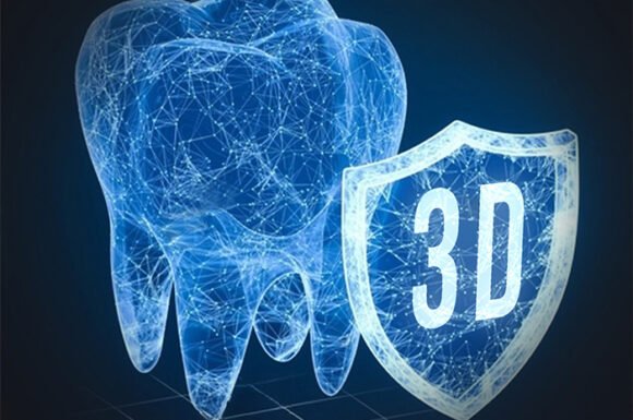 3D Guided Implant