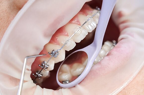 Metal Braces