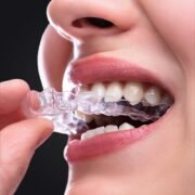Aligner-1.jpg