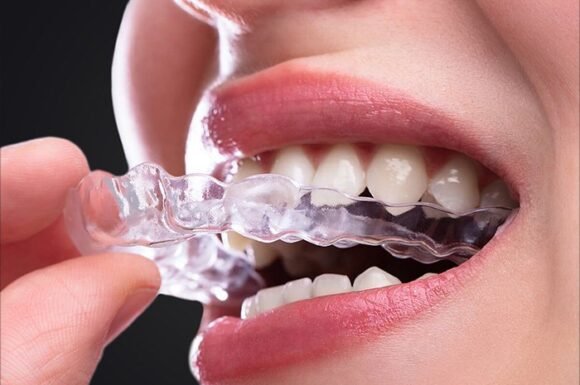 Porcelain Clear Braces